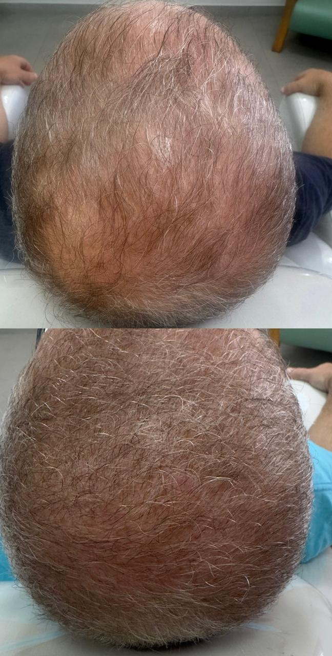 Evolução capilar — antes e depois