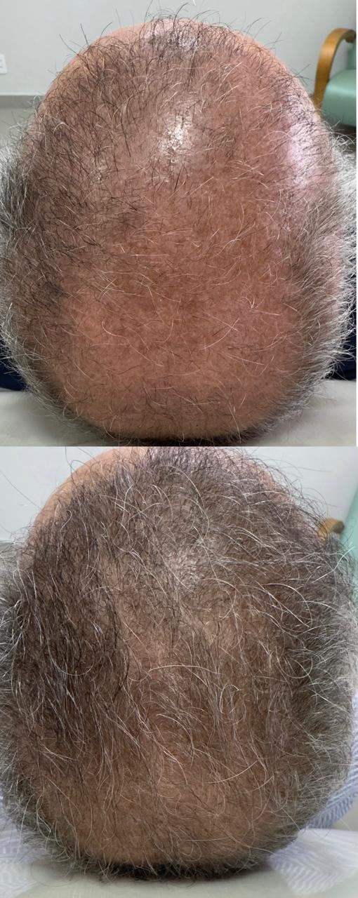 Evolução capilar — antes e depois