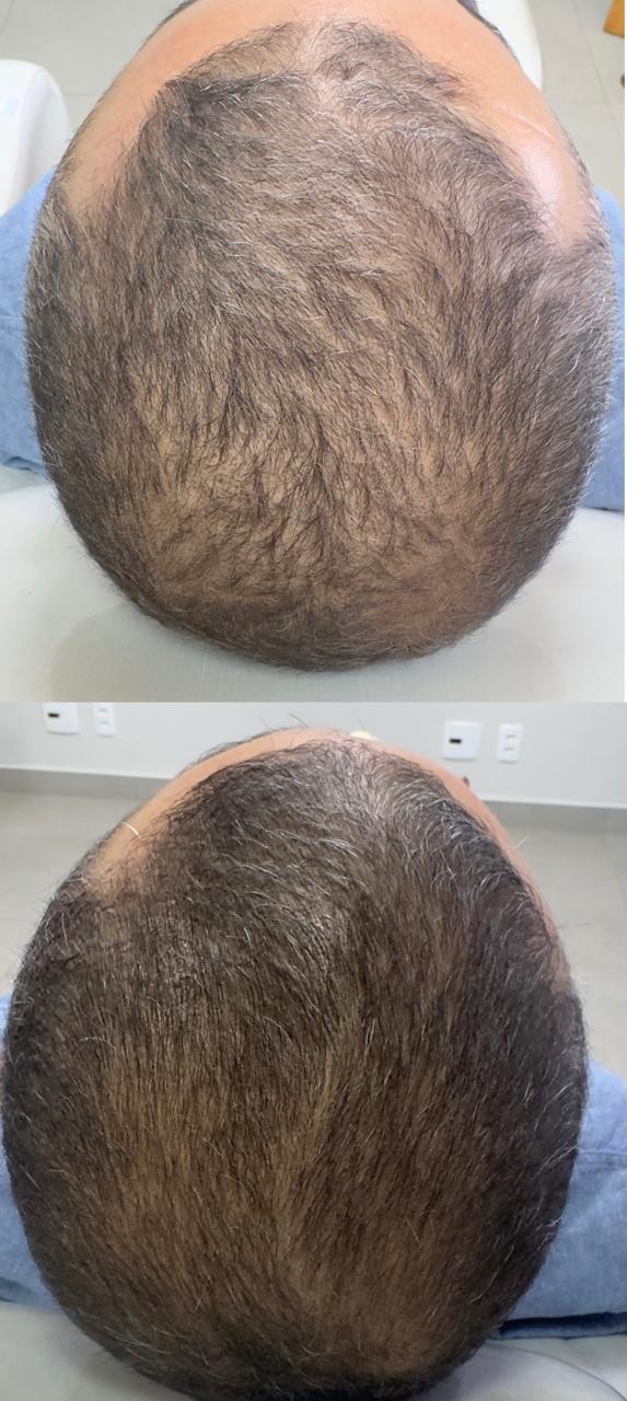 Evolução capilar — antes e depois