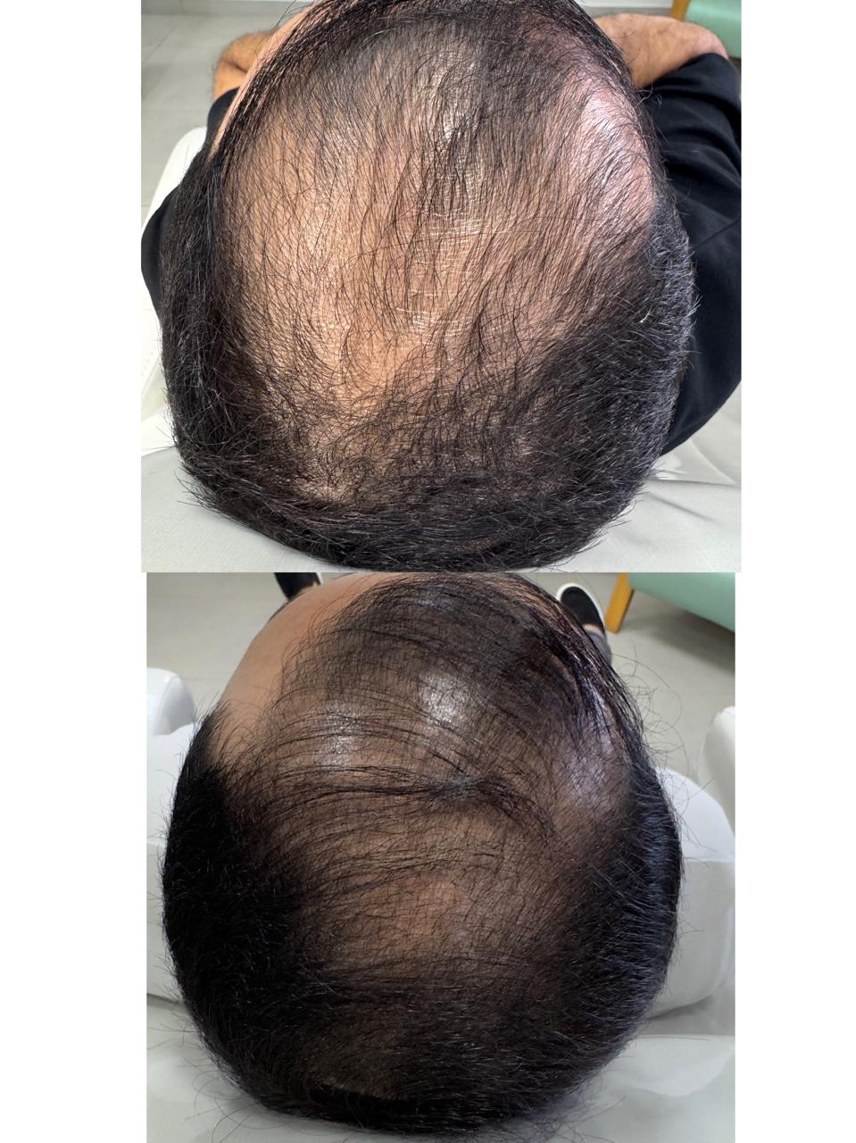 Evolução capilar — linha frontal