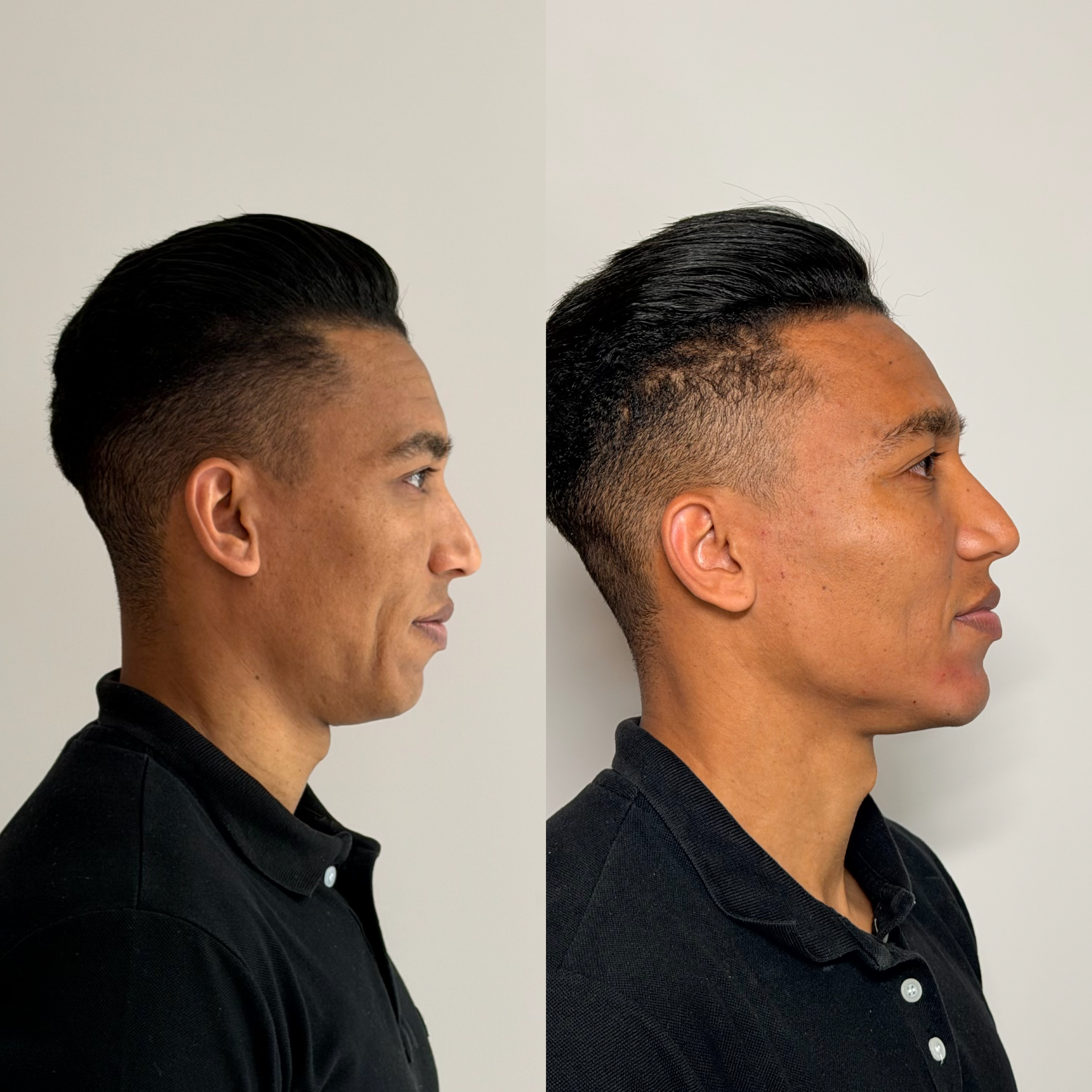 Harmonização facial — antes e depois