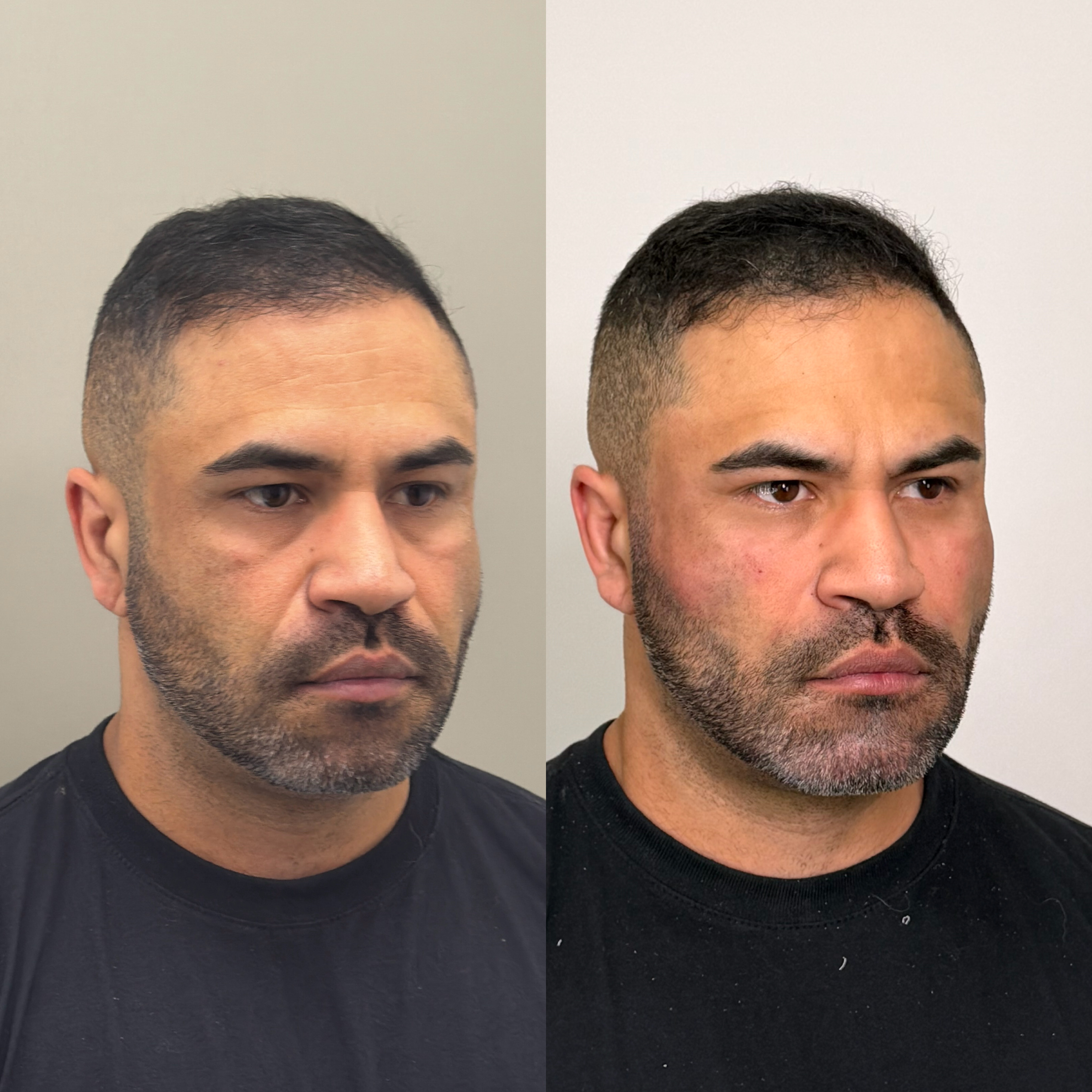 Harmonização facial — antes e depois