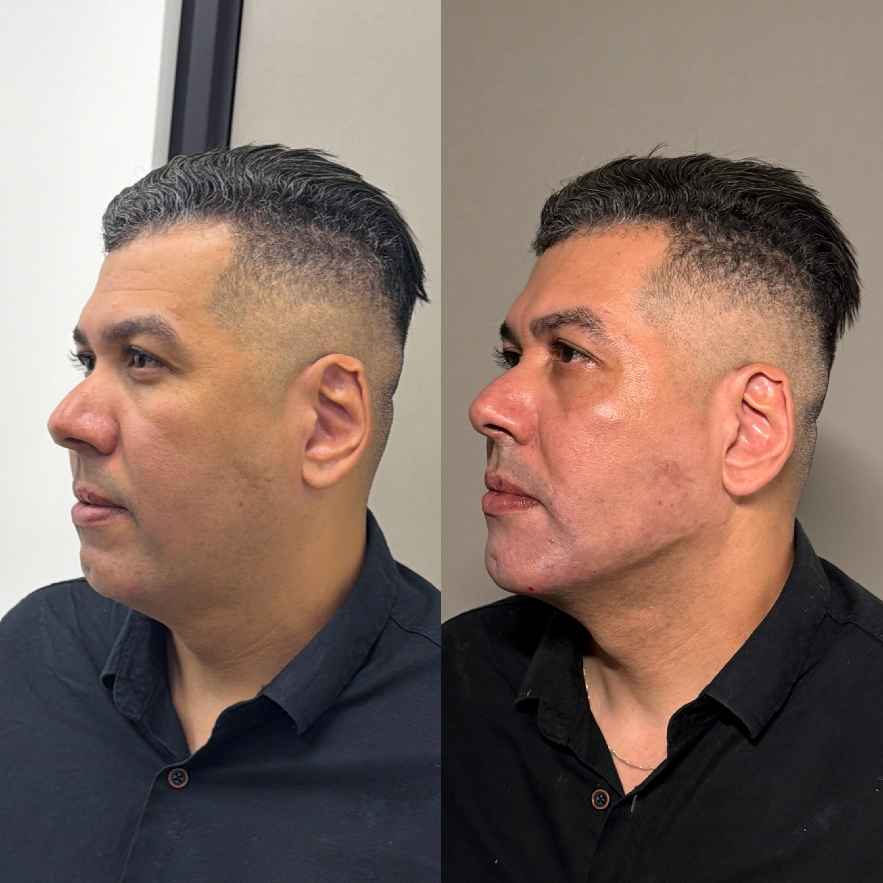 Harmonização facial — antes e depois