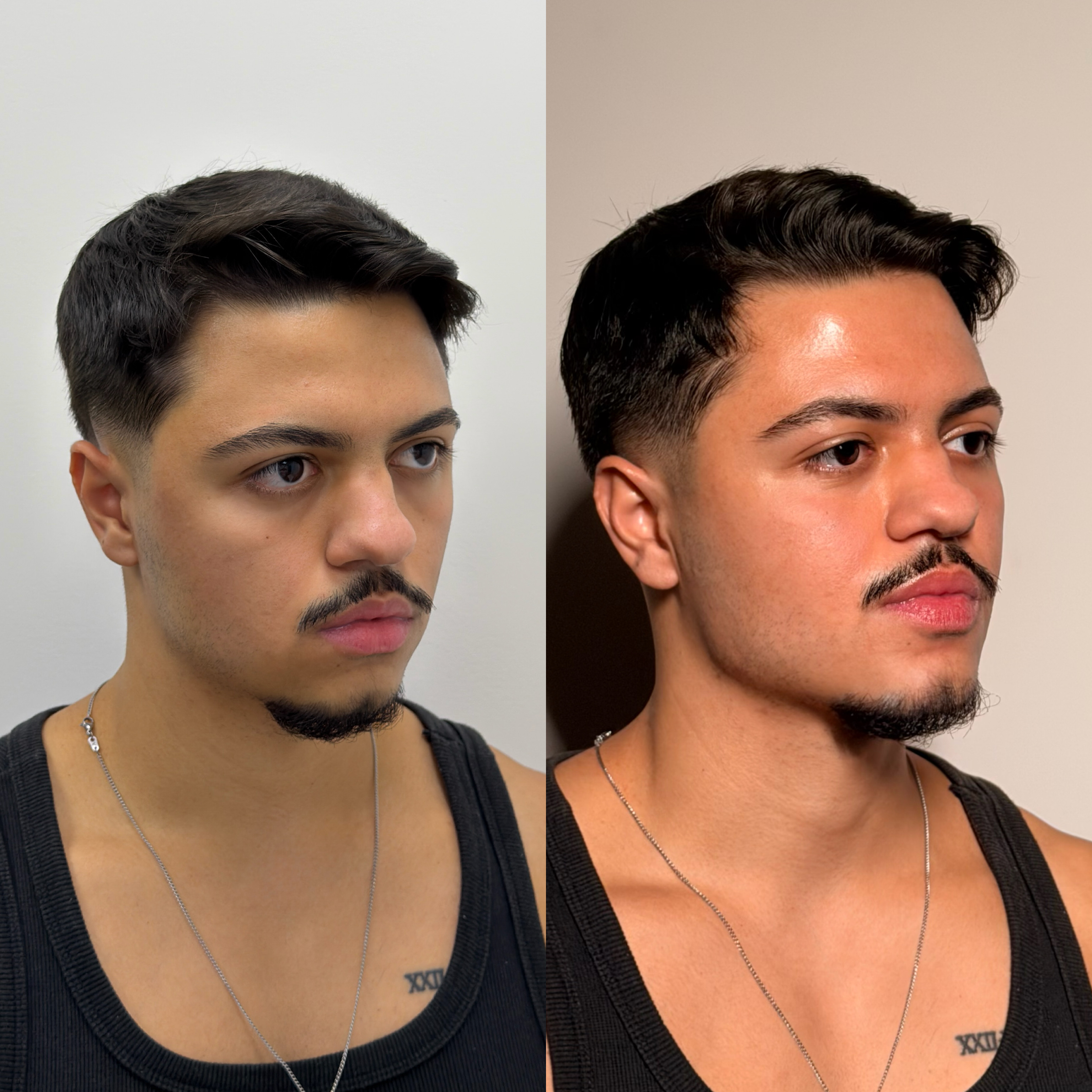 Harmonização facial — antes e depois