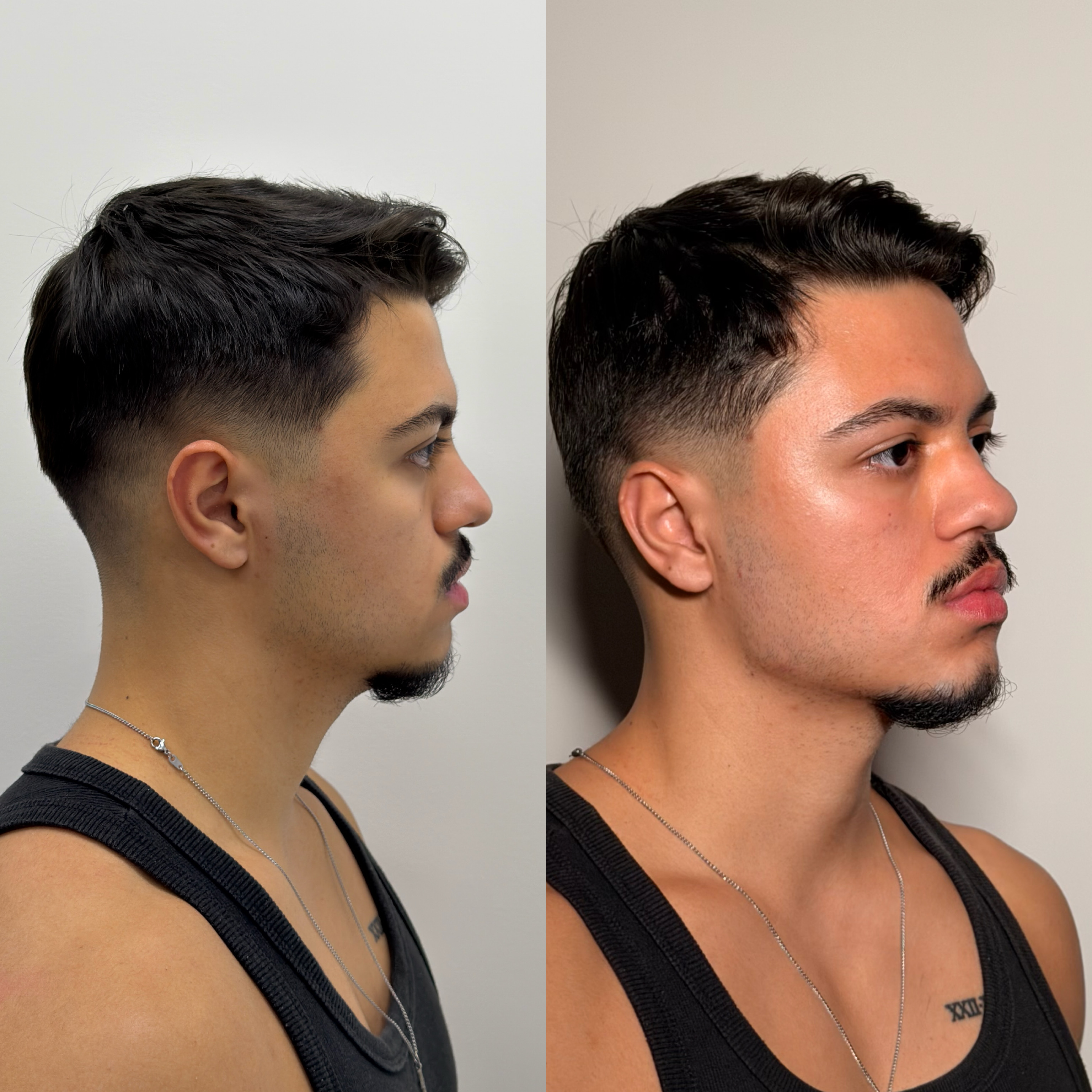 Harmonização facial — antes e depois