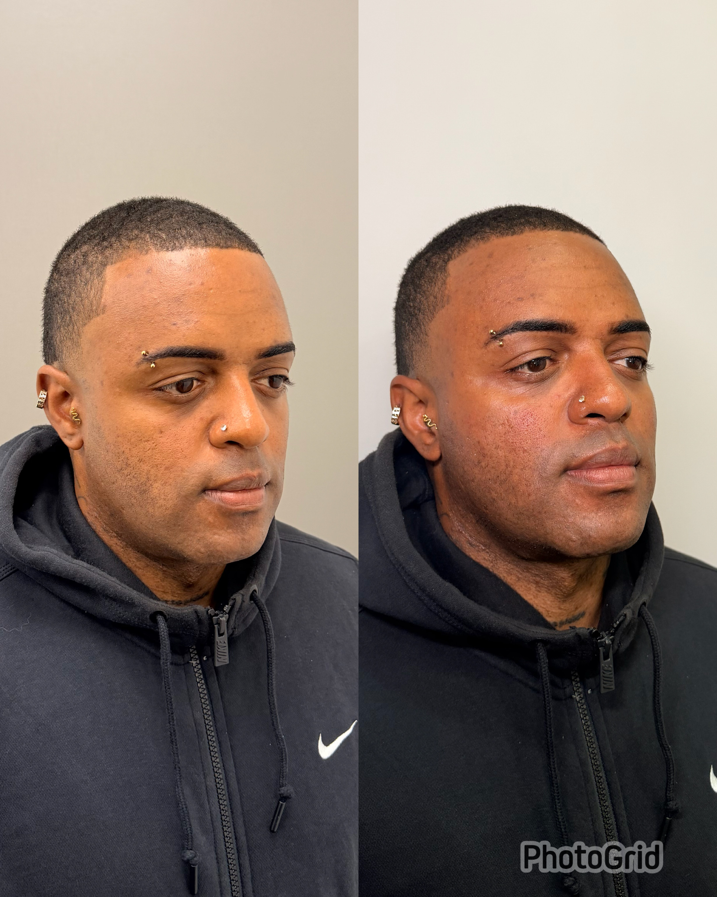 Harmonização facial — antes e depois